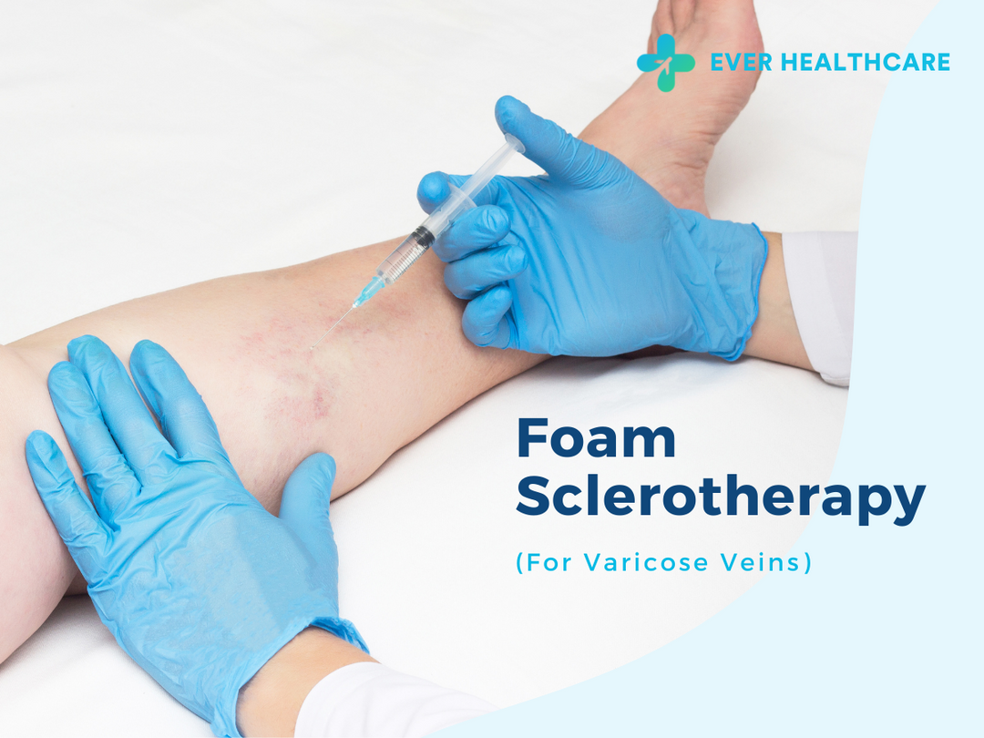 Foam Sclerotherapy for Varicose Veins in Thailand 2022 Compare Price